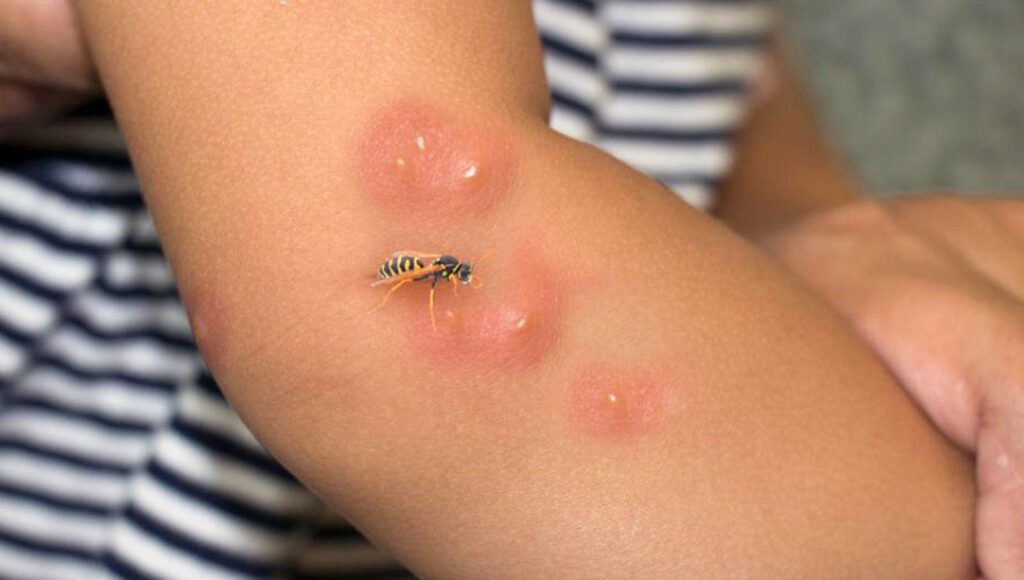 Tratamiento de una picadura, una de las intervenciones más comunes de primeros auxilios en salidas escolares al aire libre.